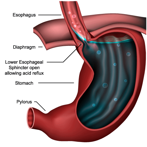 Wireless esophagus PHmetry Test Dubai Gastroenterology Clinic